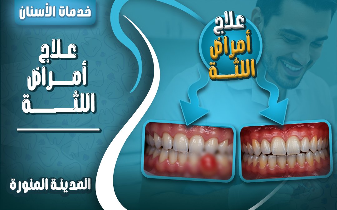 علاج اللثة