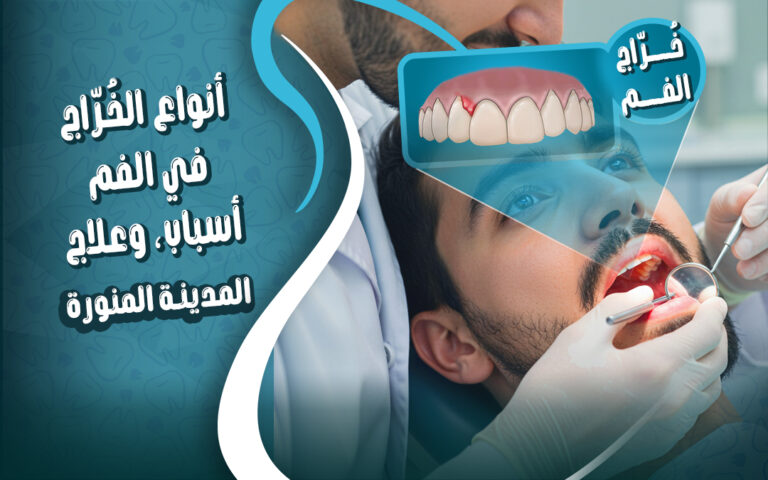 اسباب و علاج و انواع الخراج في الفم