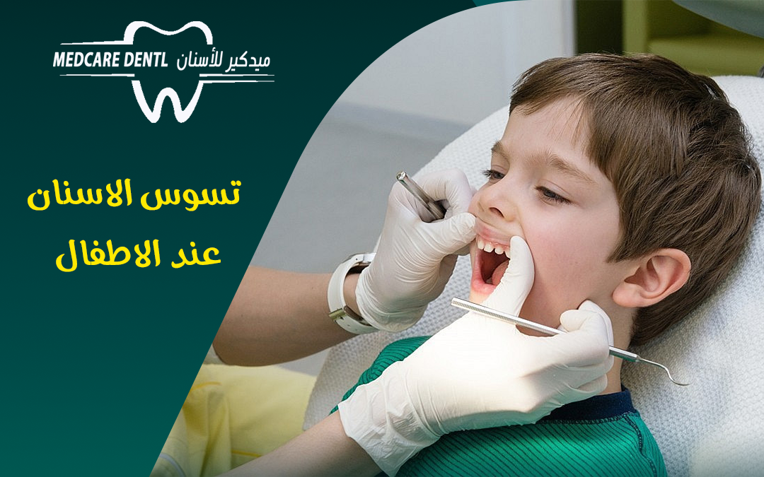 اسباب تسوس الاسنان عند الاطفال