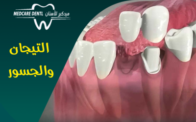 تركيب وتعويض الأسنان: التيجان و الجسور
