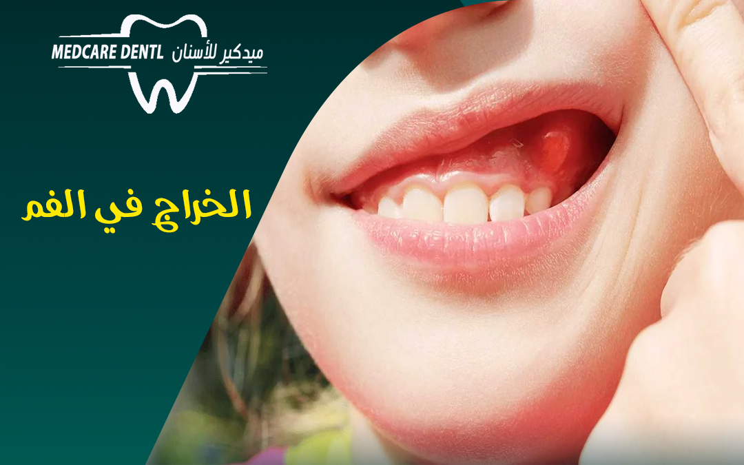 اسباب و علاج و انواع الخراج في الفم