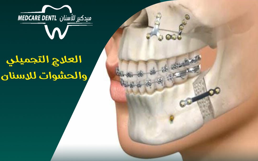 العلاج التجميلي والحشوات