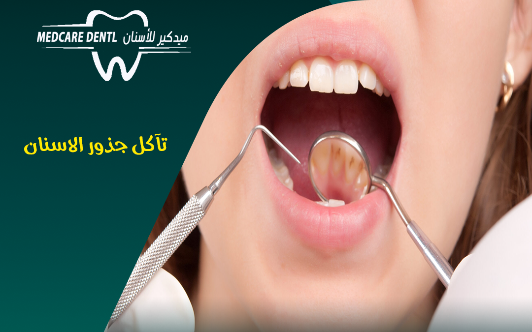 علاج تاكل جذور الاسنان بالمدينة المنورة قبل فوات الأوان!