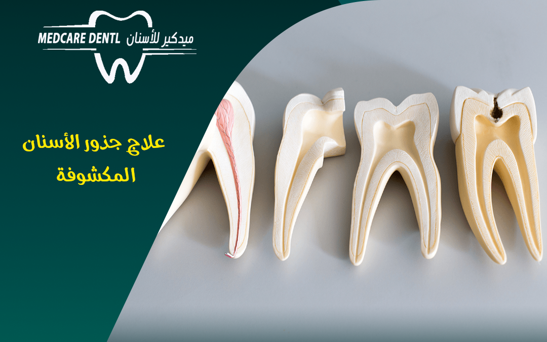 اسباب و علاج جذور الأسنان المكشوفة و نصائح للوقاية