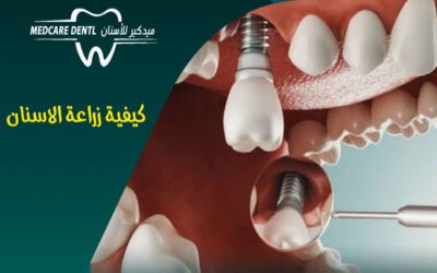 كيفية زراعة الاسنان – طريقك لتعويض أسنانك المفقودة