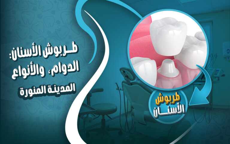 اشطر دكتور لتركيب طربوش الاسنان بالمدينة المنورة