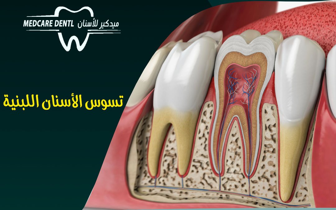 علاج جذور الاسنان