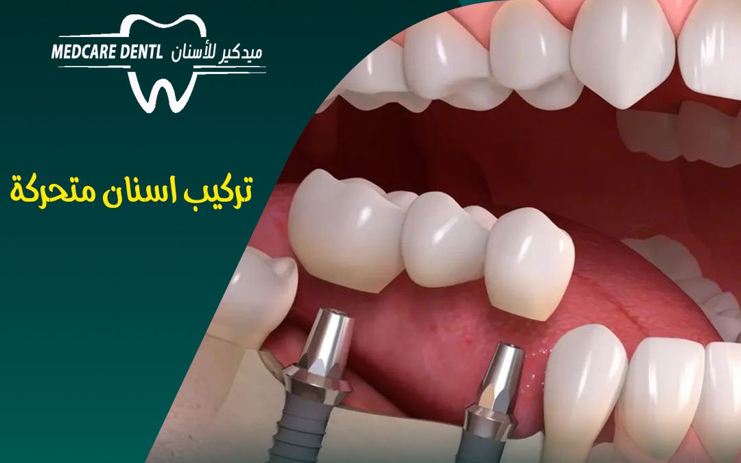 عيادة تركيب اسنان متحركة بالمدينة المنورة