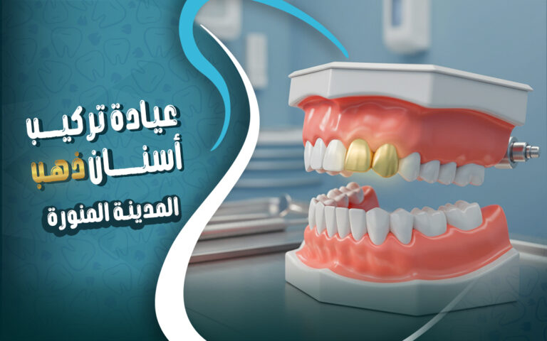 عيادة تركيب اسنان ذهب في المدينة المنورة قربان