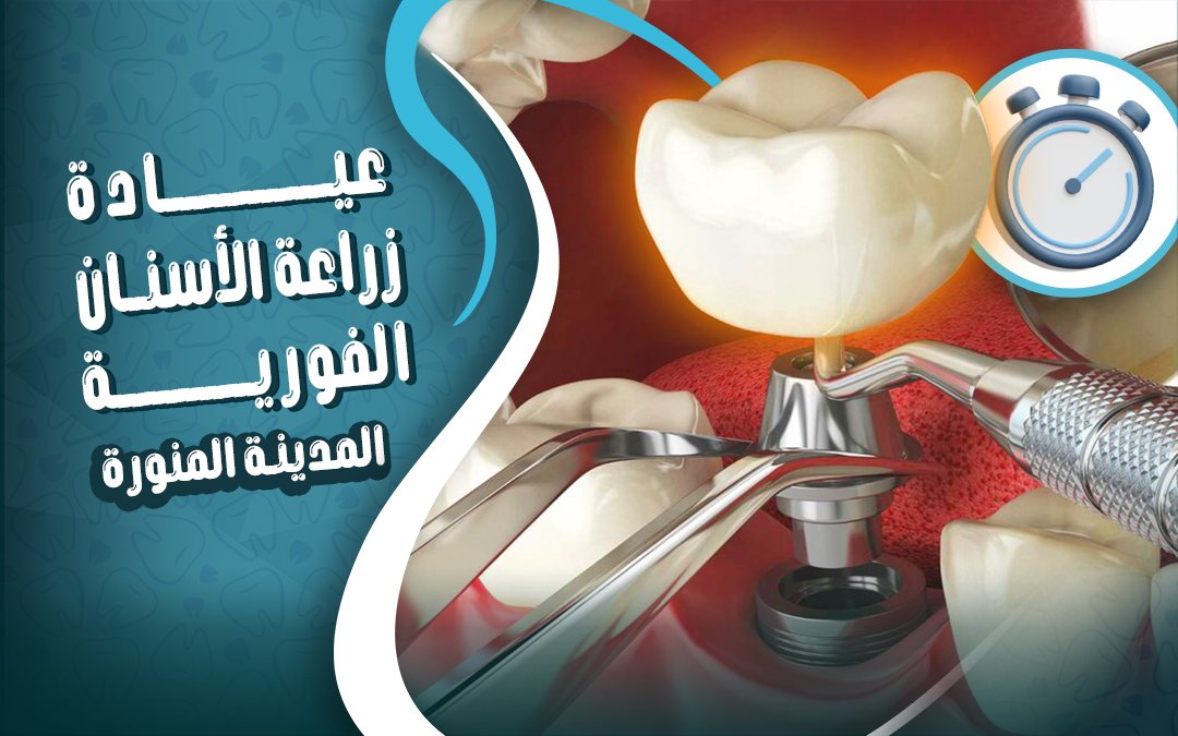 عيادة زراعة الأسنان الفورية في المدينة المنورة